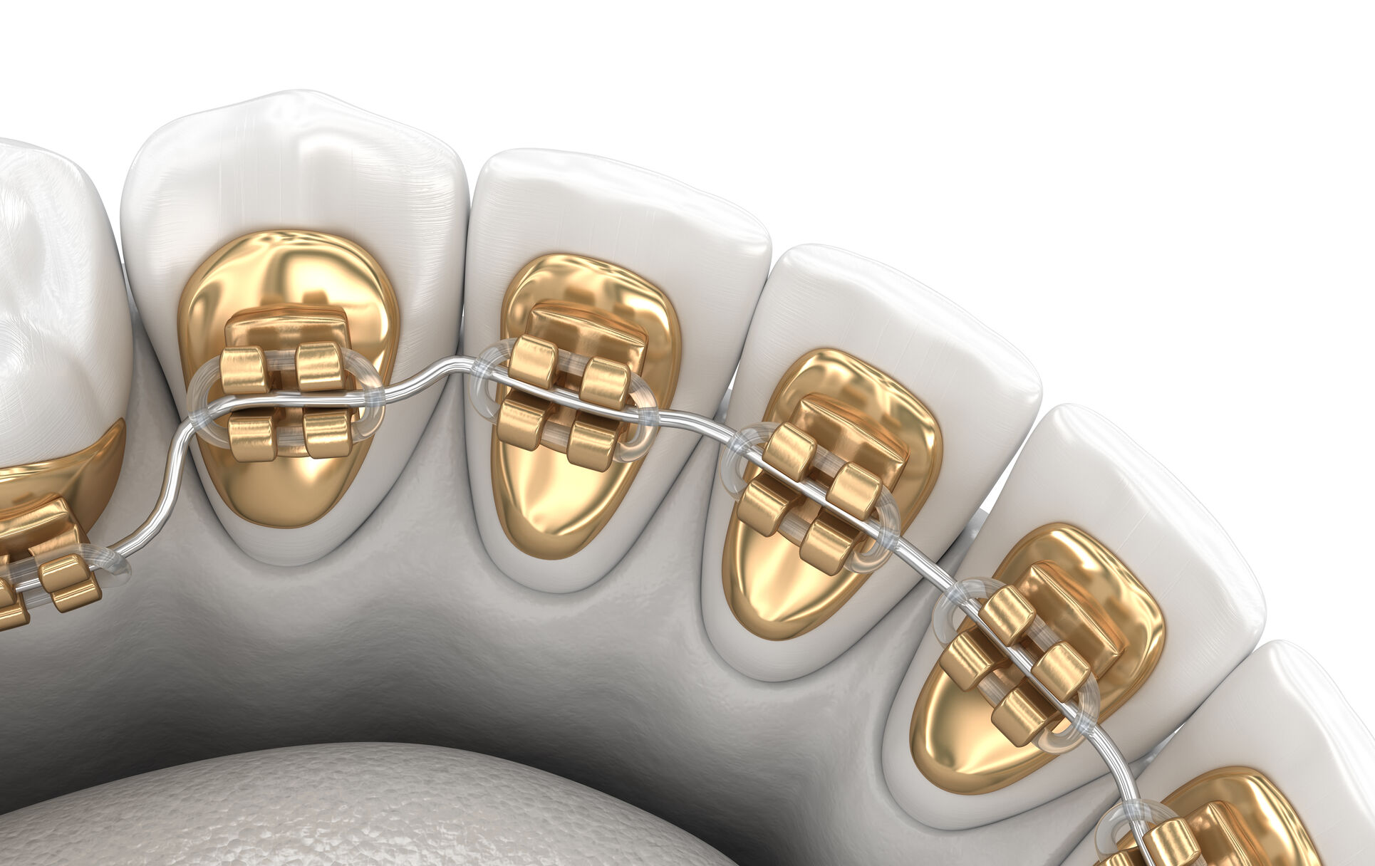 Orthodontie linguale