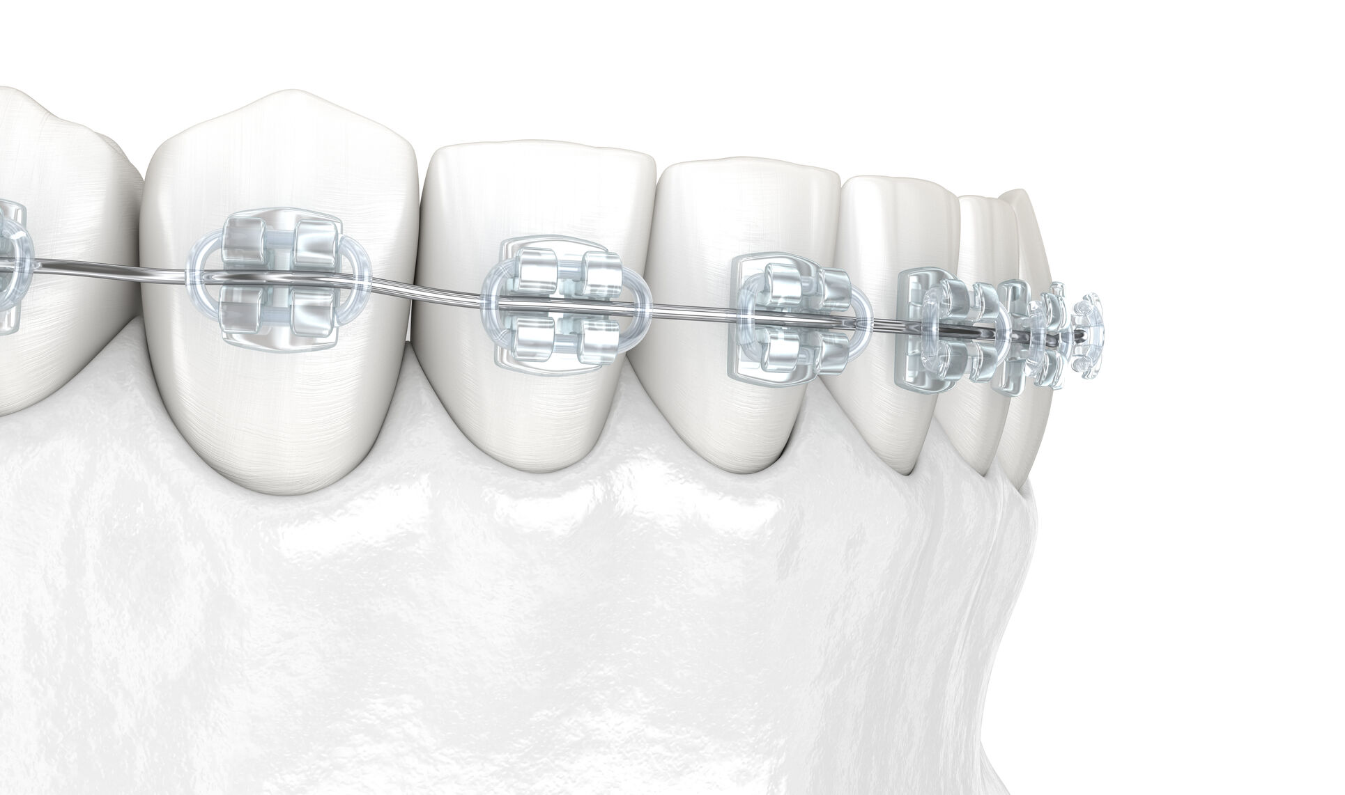 Orthodontie céramique